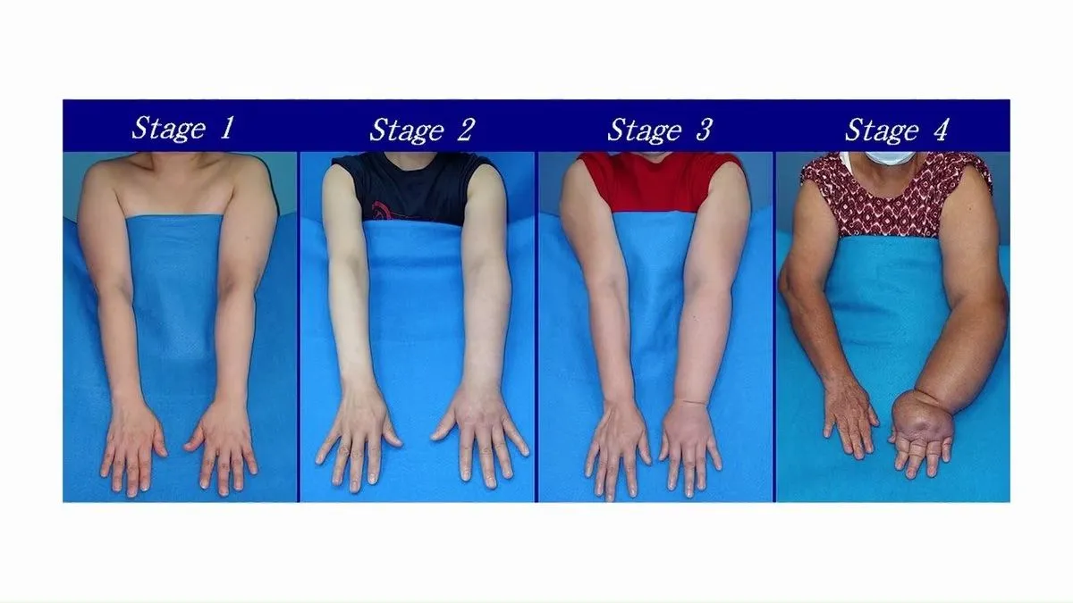 Lipedema