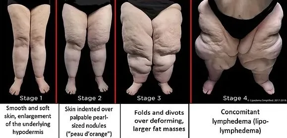 Lipedema